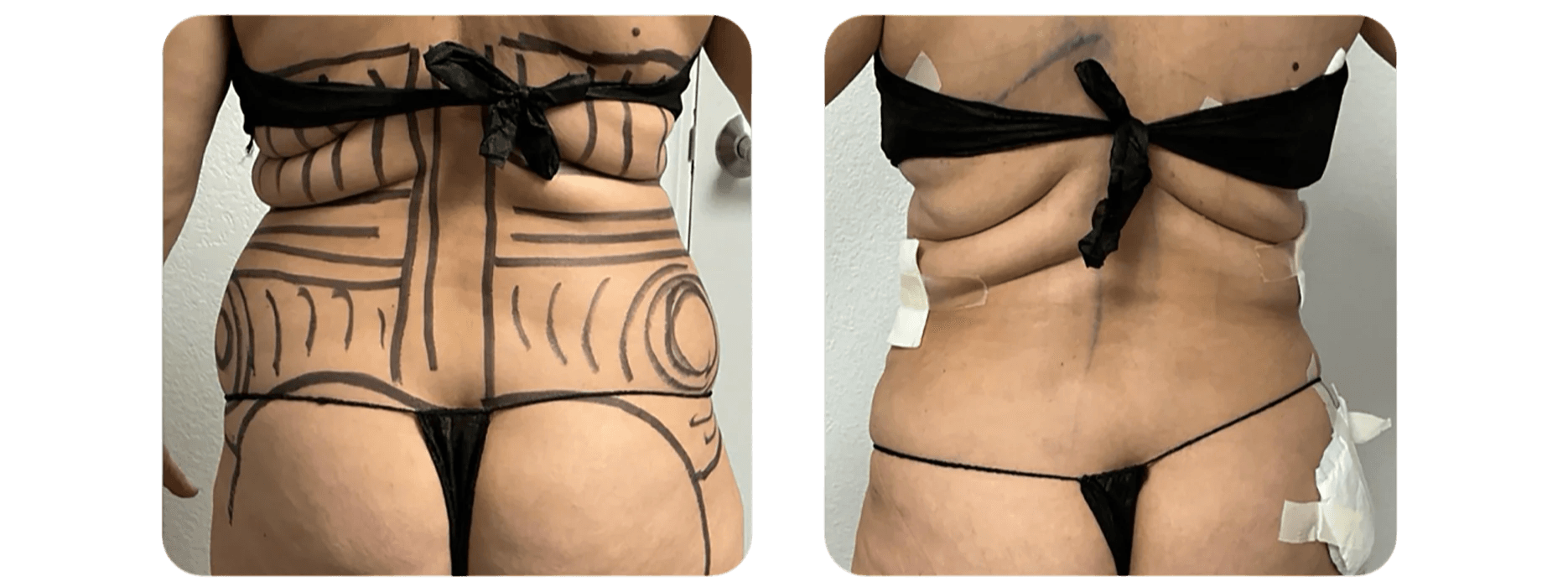 Liposuction - Abdomen and Flanks
