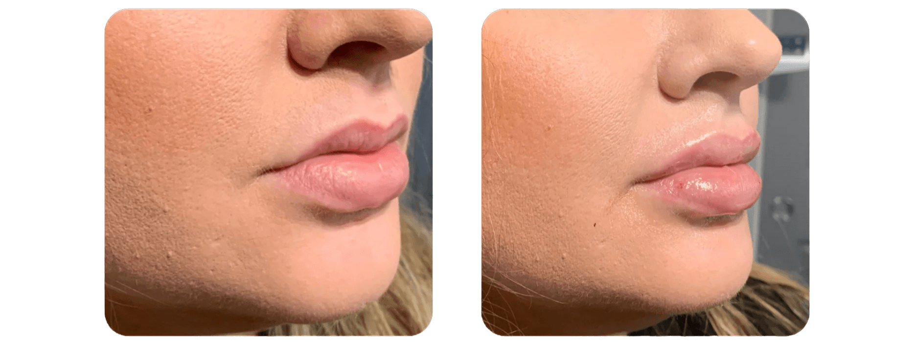 Dermal filler treatment - lip enhancement and volume restoration results