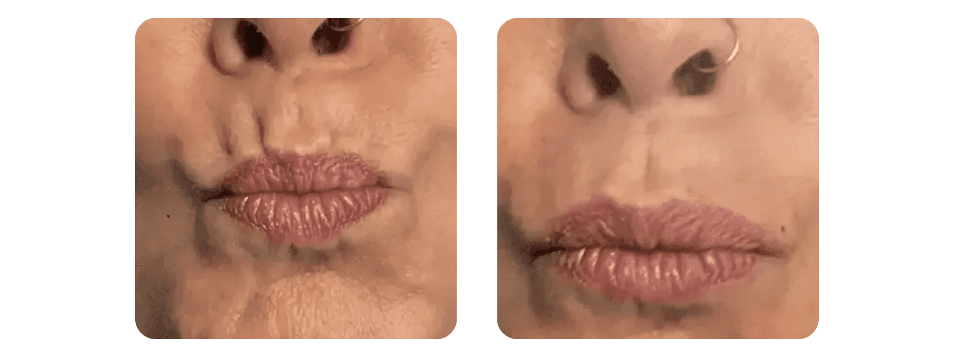 Neurotoxin treatment - before and after lip area smoothing