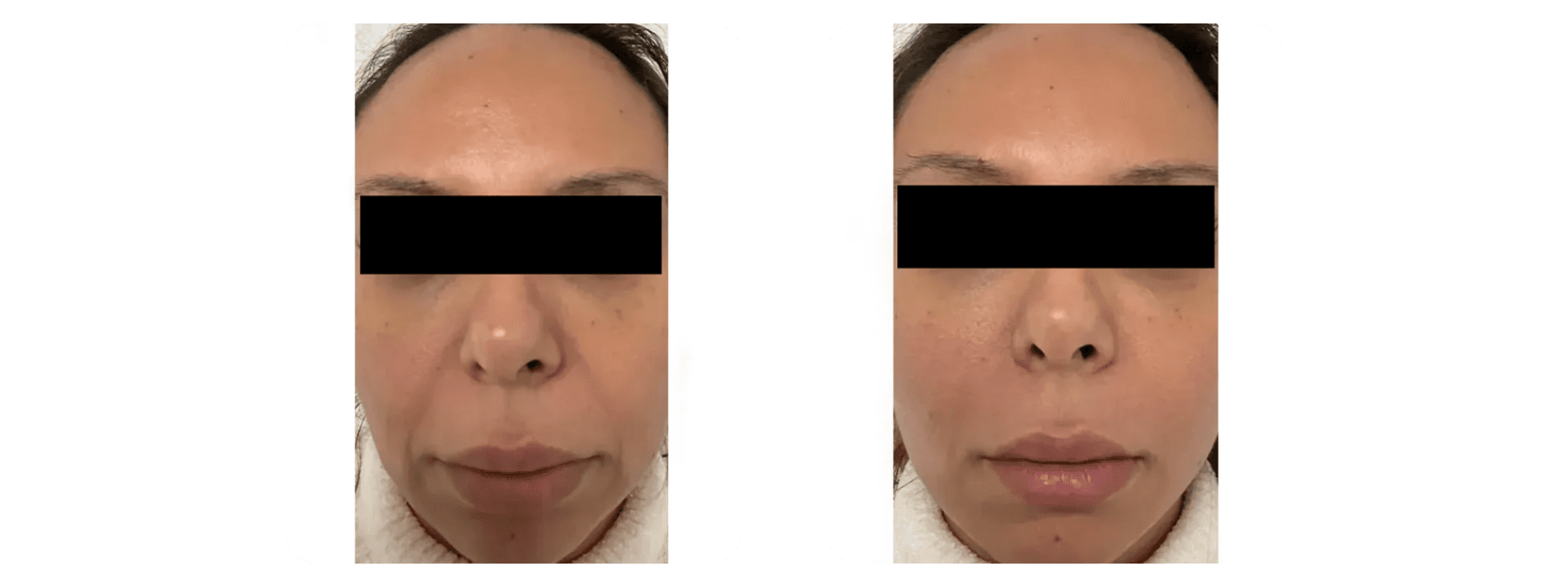 PDO Thread Lift Results - Mid-Face and Lower Face Rejuvenation