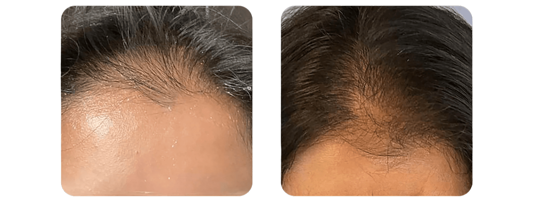 TED Hair Restoration - Hairline Improvement