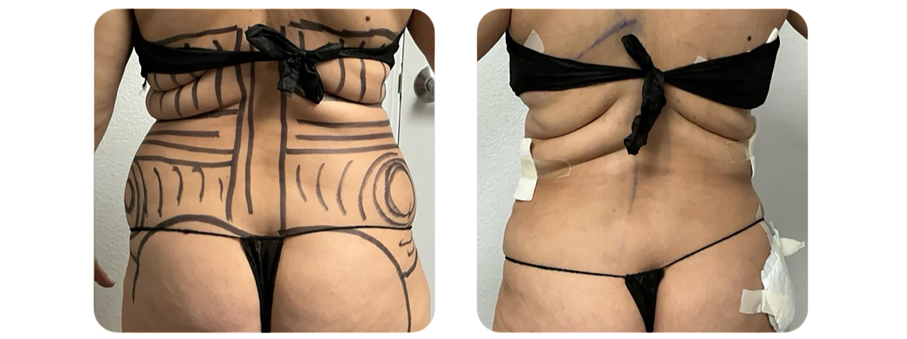 Liposuction - Abdomen and Flanks