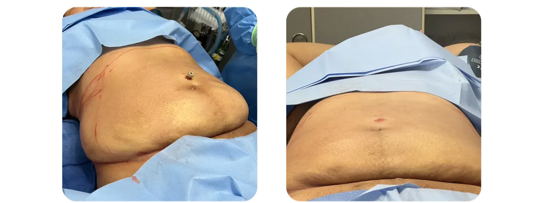 Liposuction - Abdomen Contouring