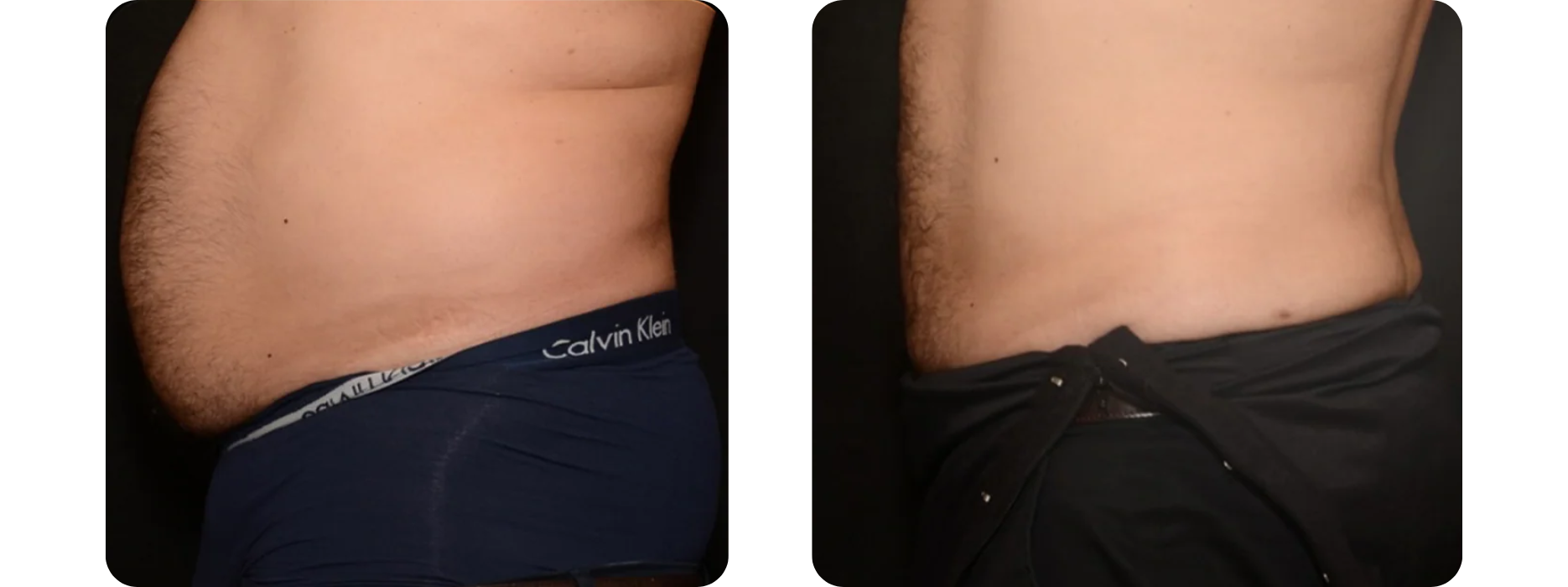 Liposuction - Male Abdomen