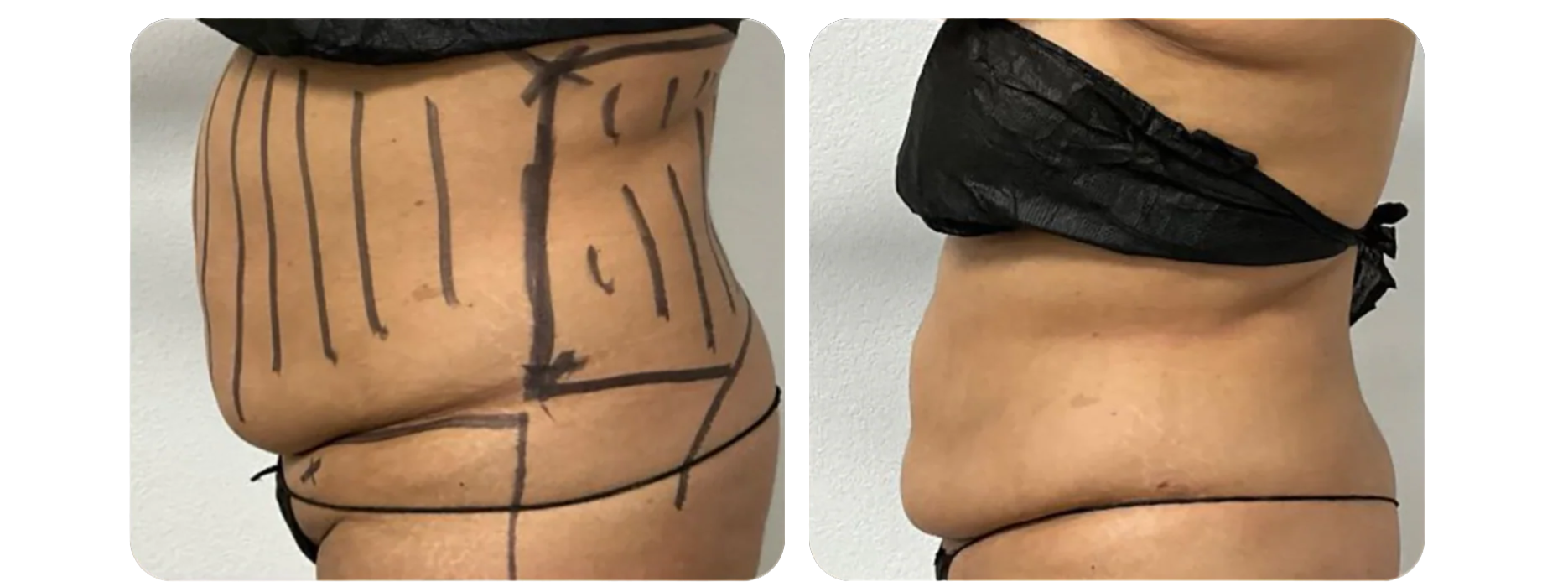 Liposuction - Back and Flanks