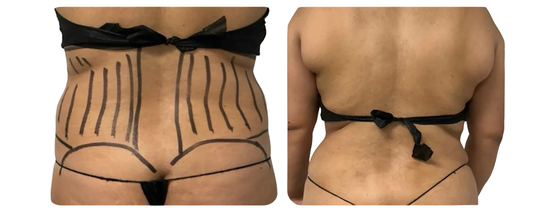 Liposuction - Abdomen Full Body